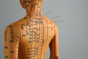 Tratamento de acupuntura

